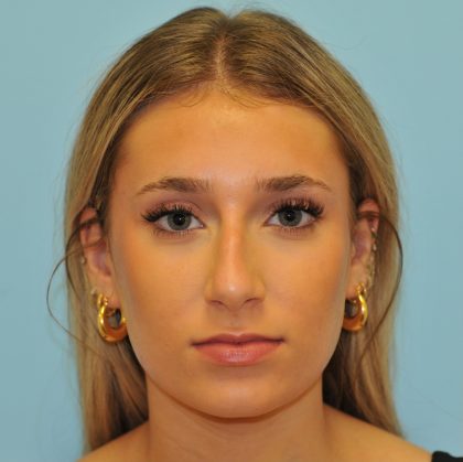 Rhinoplasty Before & After Patient #2829