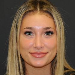 Rhinoplasty Before & After Patient #2829