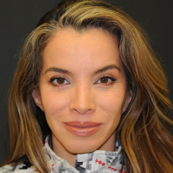 Rhinoplasty Before & After Patient #2847