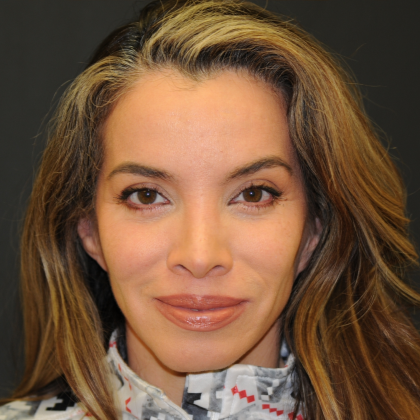 Rhinoplasty Before & After Patient #2847