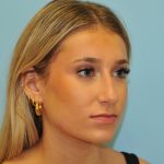 Rhinoplasty Before & After Patient #2829