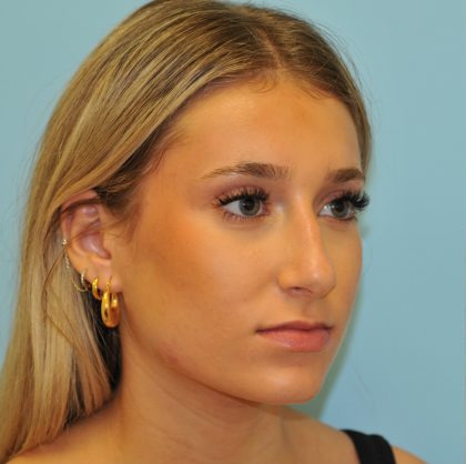 Rhinoplasty Before & After Patient #2829