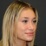 Rhinoplasty Before & After Patient #2829