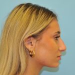 Rhinoplasty Before & After Patient #2829