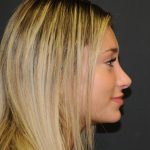 Rhinoplasty Before & After Patient #2829
