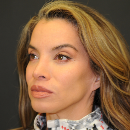 Rhinoplasty Before & After Patient #2847