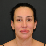 Facelift Before & After Patient #2864