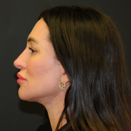 Facelift Before & After Patient #2864
