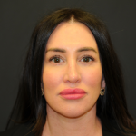 Facelift Before & After Patient #2864