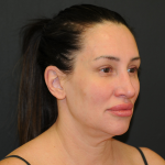 Facelift Before & After Patient #2864