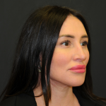Facelift Before & After Patient #2864