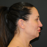 Facelift Before & After Patient #2864