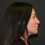Facelift Before & After Patient #2864