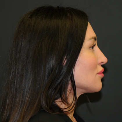 Facelift Before & After Patient #2864