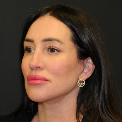 Facelift Before & After Patient #2864