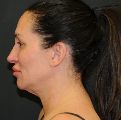 Facelift Before & After Patient #2864