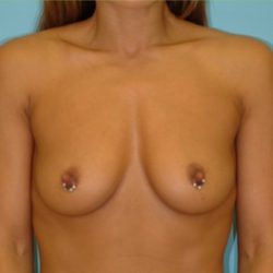 Breast Augmentation Before & After Patient #2876