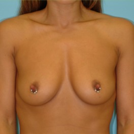 Breast Augmentation Before & After Patient #2876