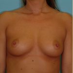 Breast Augmentation Before & After Patient #2885
