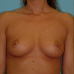 Breast Augmentation Before & After Patient #2885