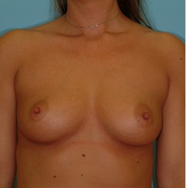 Breast Augmentation Before & After Patient #2885