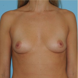 Breast Augmentation Before & After Patient #2886