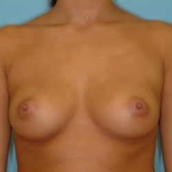 Breast Augmentation Before & After Patient #2875