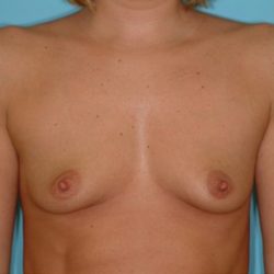 Breast Augmentation Before & After Patient #2878