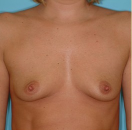 Breast Augmentation Before & After Patient #2878