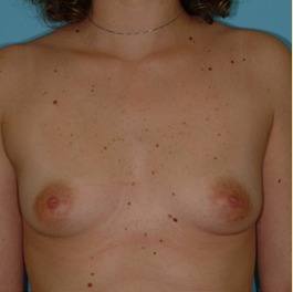 Breast Augmentation Before & After Patient #2879