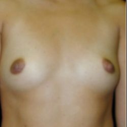 Breast Augmentation Before & After Patient #2881