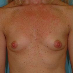 Breast Augmentation Before & After Patient #2882