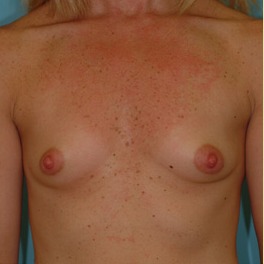 Breast Augmentation Before & After Patient #2882