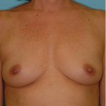 Breast Augmentation Before & After Patient #2883