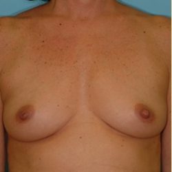 Breast Augmentation Before & After Patient #2883