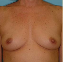 Breast Augmentation Before & After Patient #2883