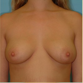 Breast Augmentation Before & After Patient #2884