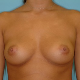 Breast Augmentation Before & After Patient #2875