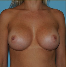 Breast Augmentation Before & After Patient #2886