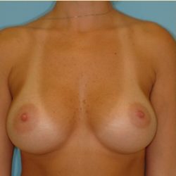 Breast Augmentation Before & After Patient #2880