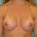 Breast Augmentation Before & After Patient #2882
