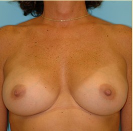Breast Augmentation Before & After Patient #2883