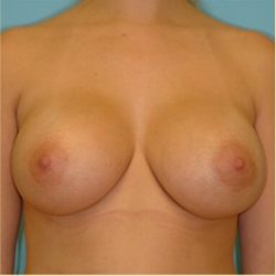 Breast Augmentation Before & After Patient #2884