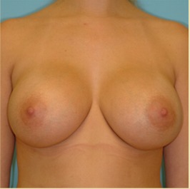 Breast Augmentation Before & After Patient #2884