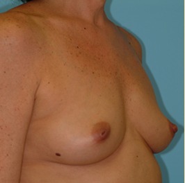 Breast Augmentation Before & After Patient #2883