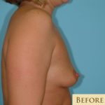 Breast Augmentation Before & After Patient #2878