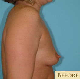 Breast Augmentation Before & After Patient #2878