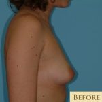 Breast Augmentation Before & After Patient #2879