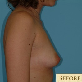 Breast Augmentation Before & After Patient #2879