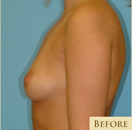 Breast Augmentation Before & After Patient #2880